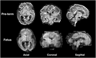 Through-Plane Super-Resolution With Autoencoders in Diffusion Magnetic Resonance Imaging of the Developing Human Brain